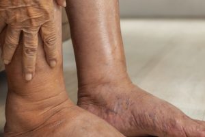 Muroff National Diabetes Month Blog